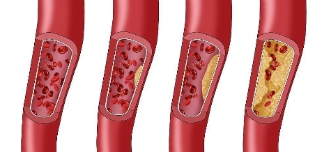 阿托伐他汀是治什么的？优选原研药、长期使用，有效降脂第一步(图1)